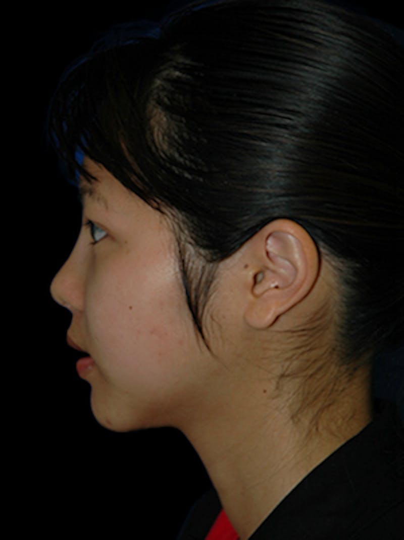Genioplasty Before & After Gallery - Patient 407692 - Image 4