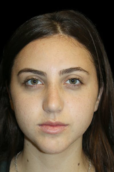 Genioplasty Before & After Gallery - Patient 390386 - Image 2