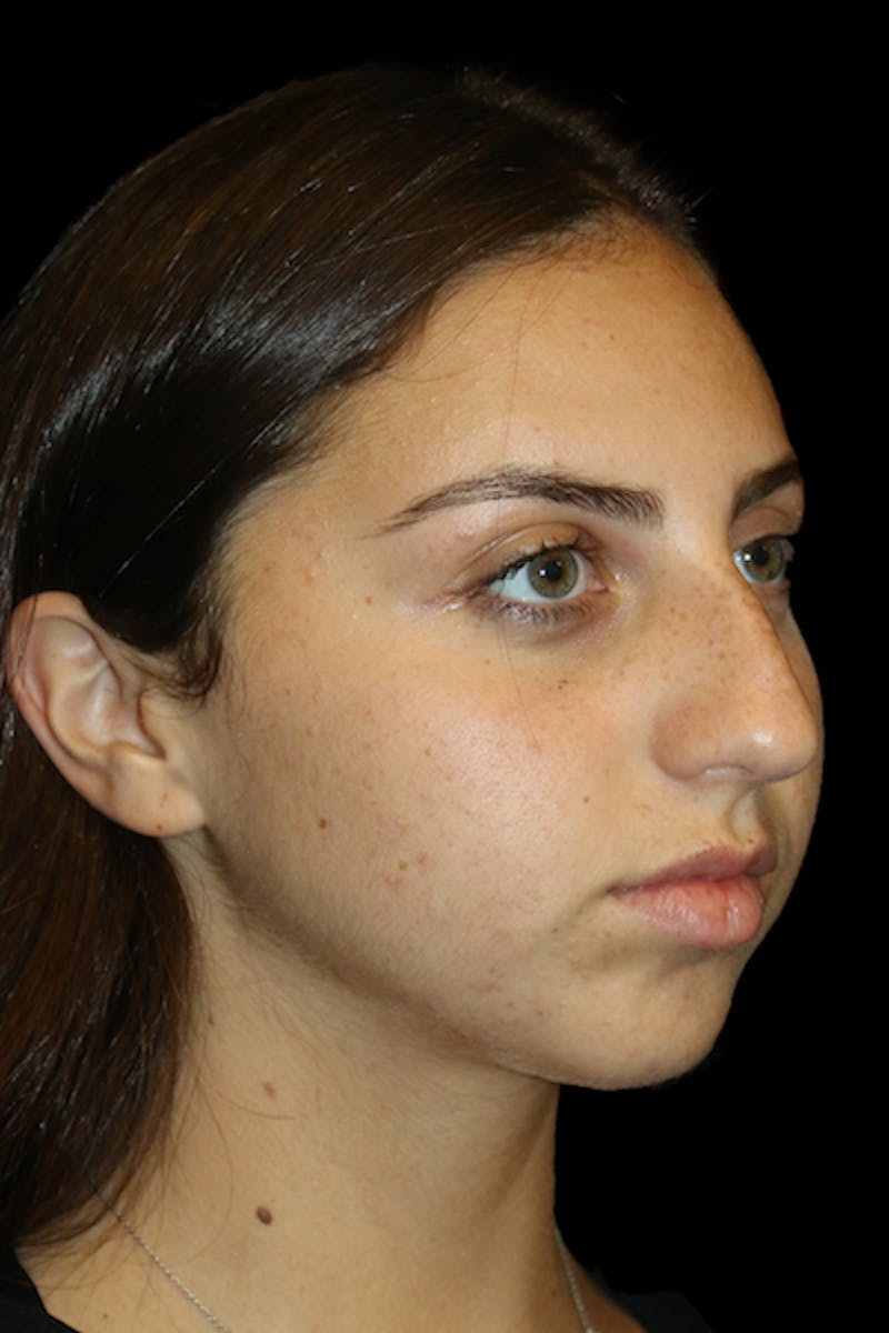 Genioplasty Before & After Gallery - Patient 390386 - Image 3