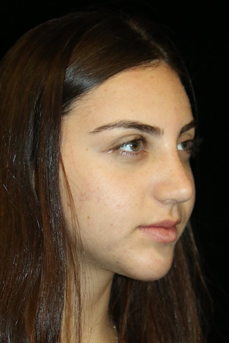 Genioplasty Before & After Gallery - Patient 390386 - Image 4