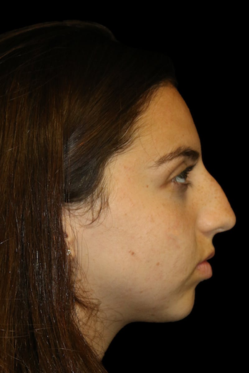 Genioplasty Before & After Gallery - Patient 390386 - Image 5