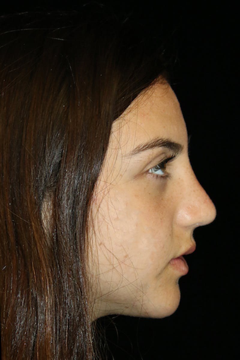 Genioplasty Before & After Gallery - Patient 390386 - Image 6