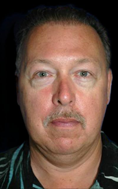 Genioplasty Before & After Gallery - Patient 688608 - Image 1