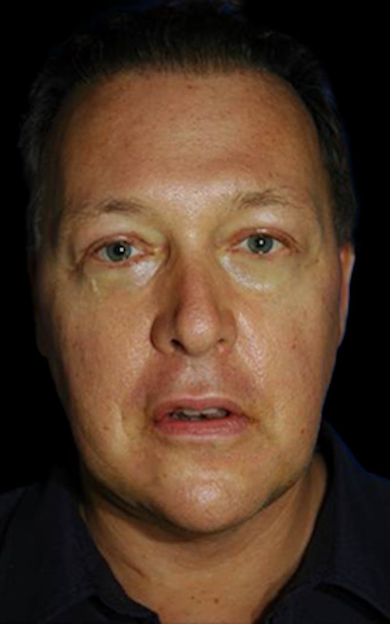 Genioplasty Before & After Gallery - Patient 688608 - Image 2