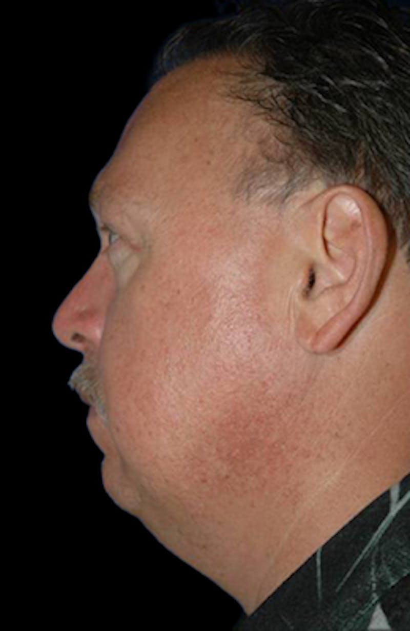 Genioplasty Before & After Gallery - Patient 688608 - Image 3