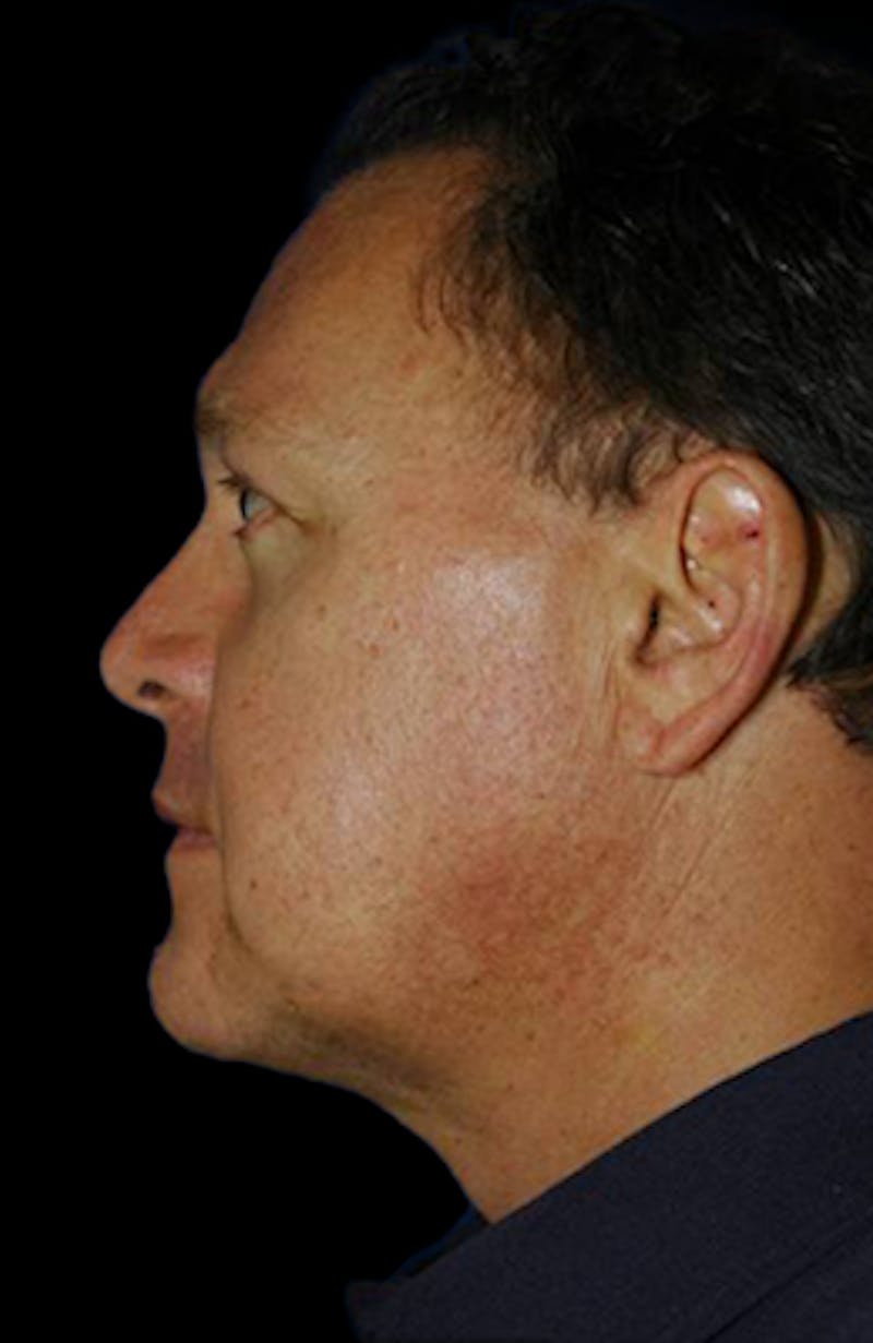 Genioplasty Before & After Gallery - Patient 688608 - Image 4
