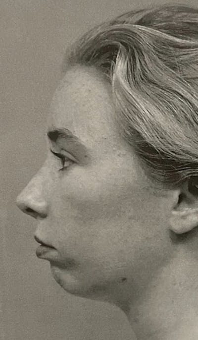 Genioplasty Before & After Gallery - Patient 353449 - Image 1