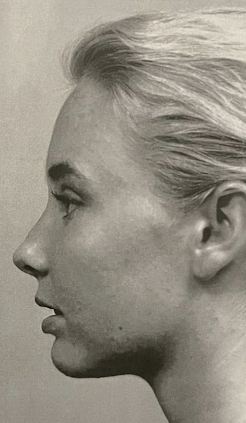 Genioplasty Before & After Gallery - Patient 353449 - Image 2