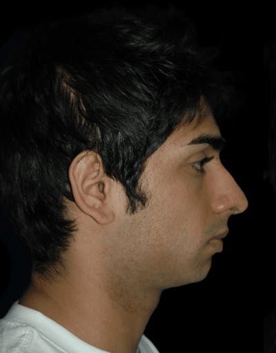 Genioplasty Before & After Gallery - Patient 581877 - Image 1