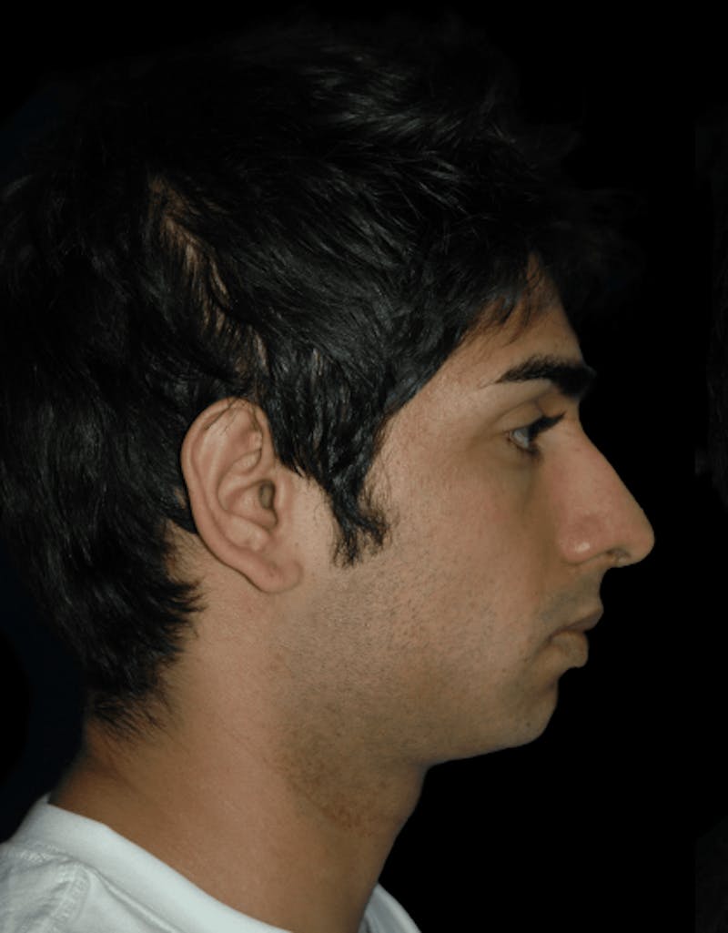 Genioplasty Before & After Gallery - Patient 581877 - Image 1