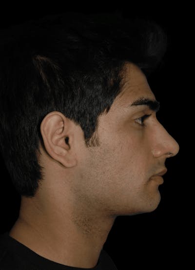Genioplasty Before & After Gallery - Patient 581877 - Image 2