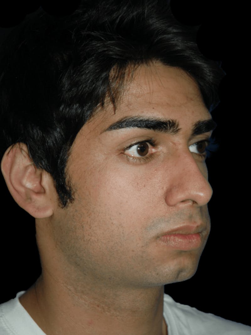 Genioplasty Before & After Gallery - Patient 581877 - Image 3