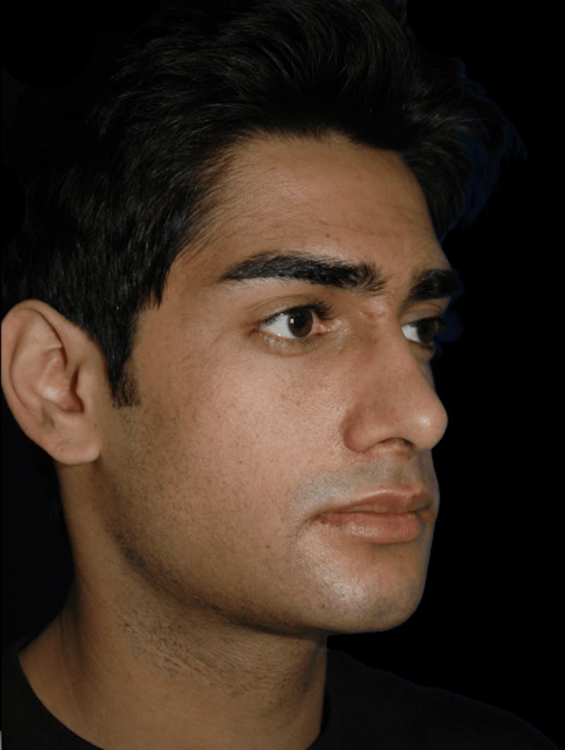 Genioplasty Before & After Gallery - Patient 581877 - Image 4