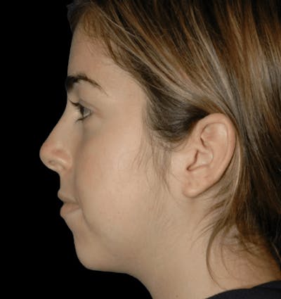 Genioplasty Before & After Gallery - Patient 480434 - Image 1
