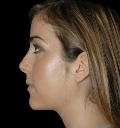 Genioplasty Before & After Gallery - Patient 480434 - Image 2