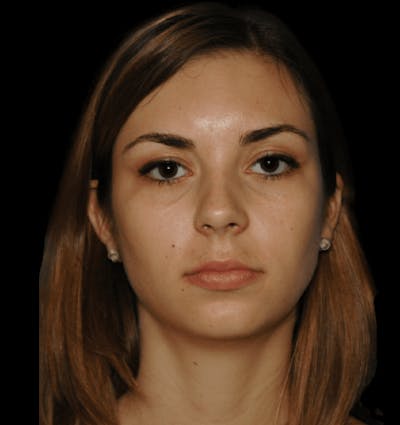 Genioplasty Before & After Gallery - Patient 178916 - Image 1