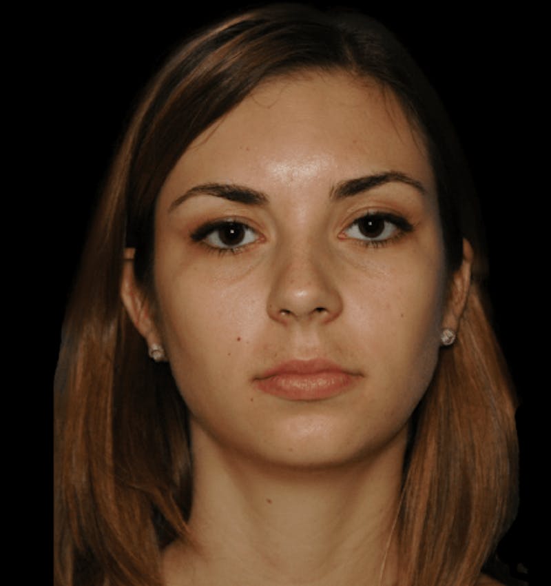 Genioplasty Before & After Gallery - Patient 178916 - Image 1