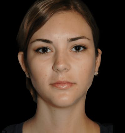 Genioplasty Before & After Gallery - Patient 178916 - Image 2