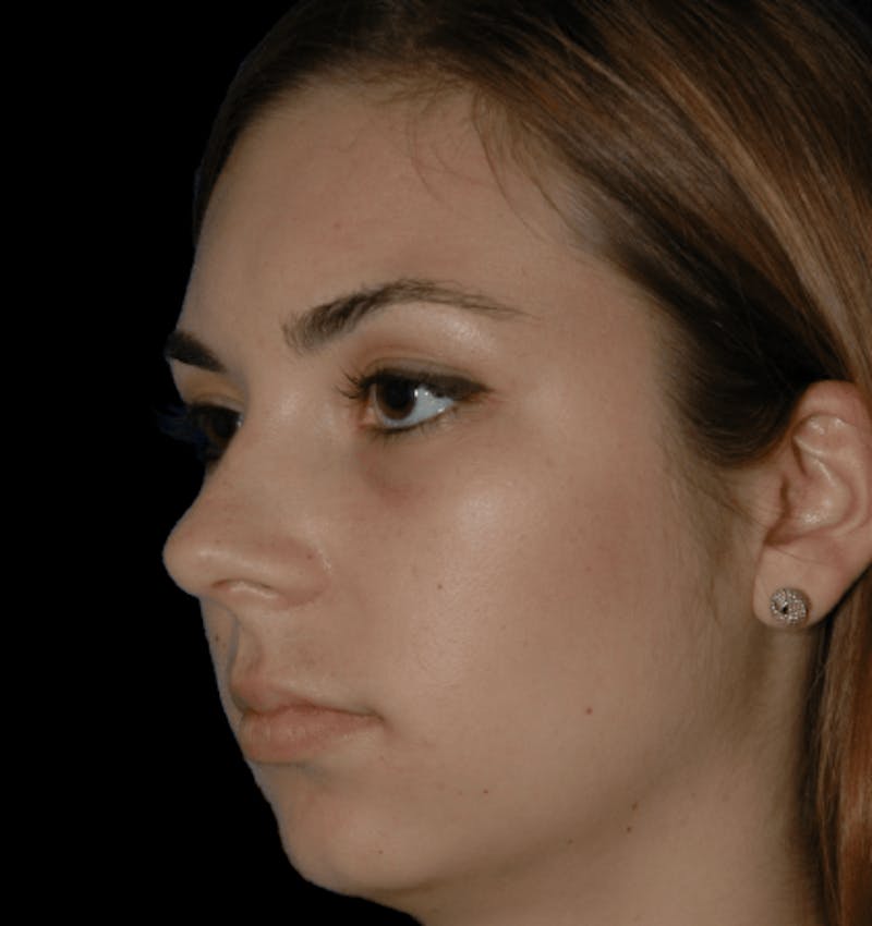 Genioplasty Before & After Gallery - Patient 178916 - Image 3