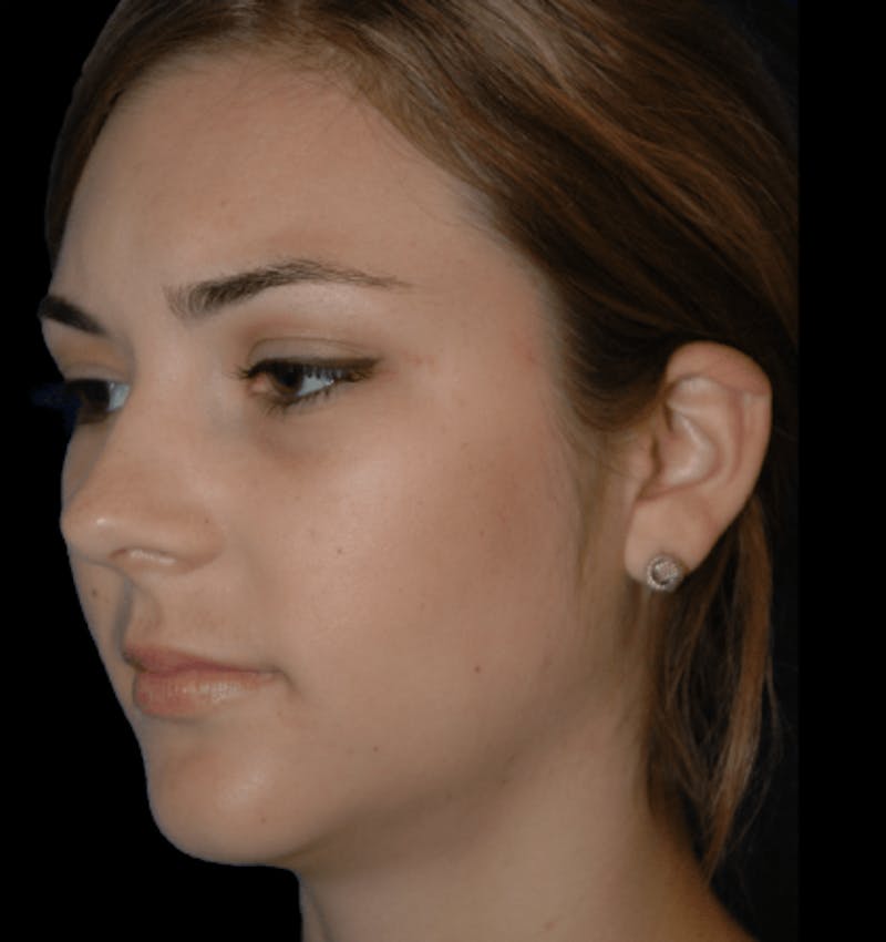 Genioplasty Before & After Gallery - Patient 178916 - Image 4