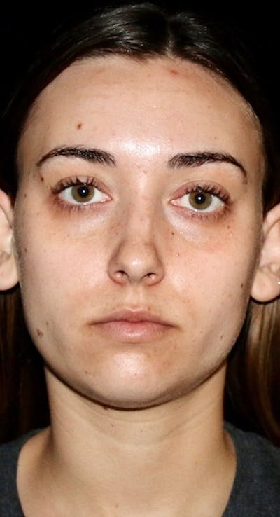 Facial Fat Grafting Before & After Gallery - Patient 349678 - Image 1