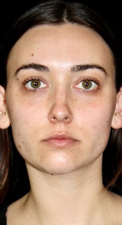 Facial Fat Grafting Before & After Gallery - Patient 349678 - Image 2