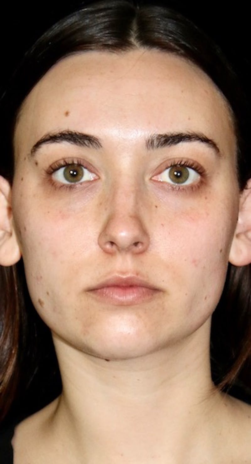 Facial Fat Grafting Before & After Gallery - Patient 349678 - Image 2