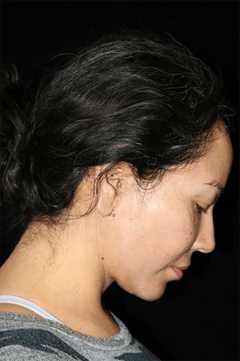 Facial Fat Grafting Before & After Gallery - Patient 107504 - Image 4