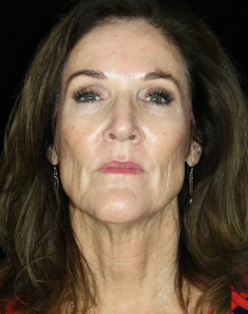 Facial Fat Grafting Before & After Gallery - Patient 221349 - Image 1