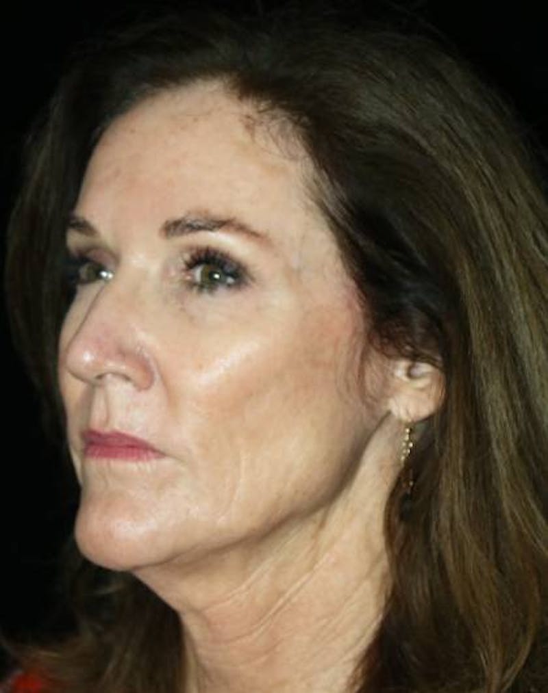 Facial Fat Grafting Before & After Gallery - Patient 221349 - Image 3