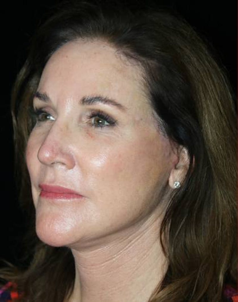 Facial Fat Grafting Before & After Gallery - Patient 221349 - Image 4
