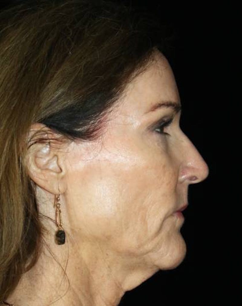 Facial Fat Grafting Before & After Gallery - Patient 221349 - Image 5
