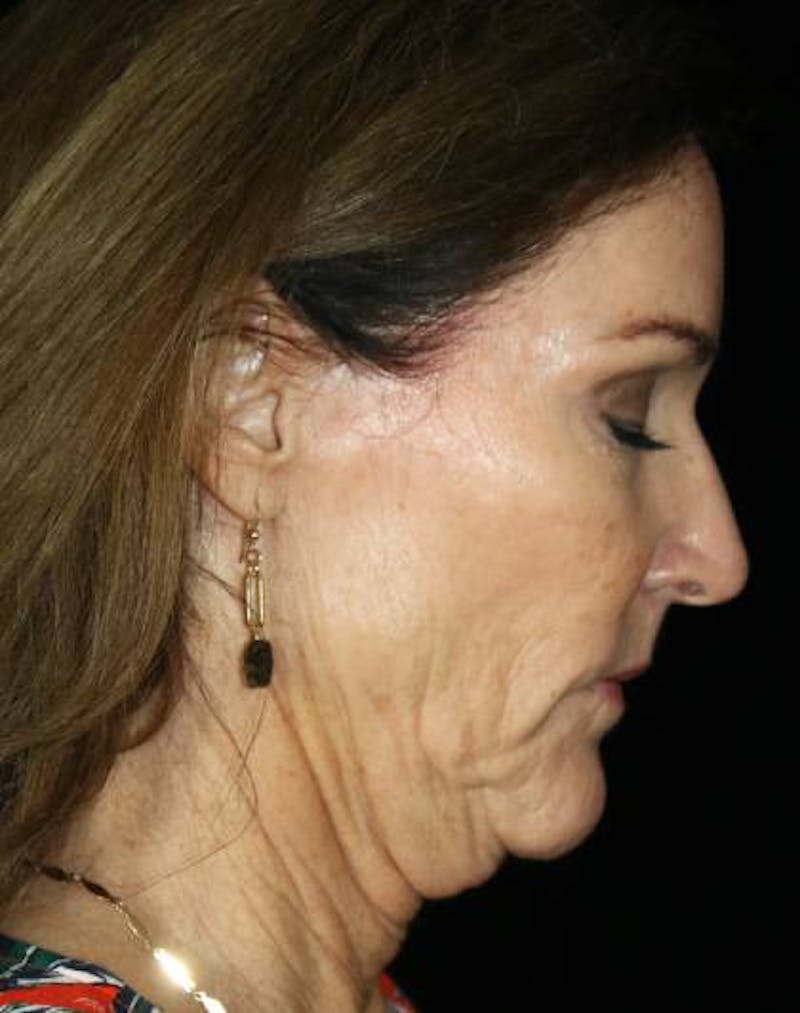 Facial Fat Grafting Before & After Gallery - Patient 221349 - Image 7