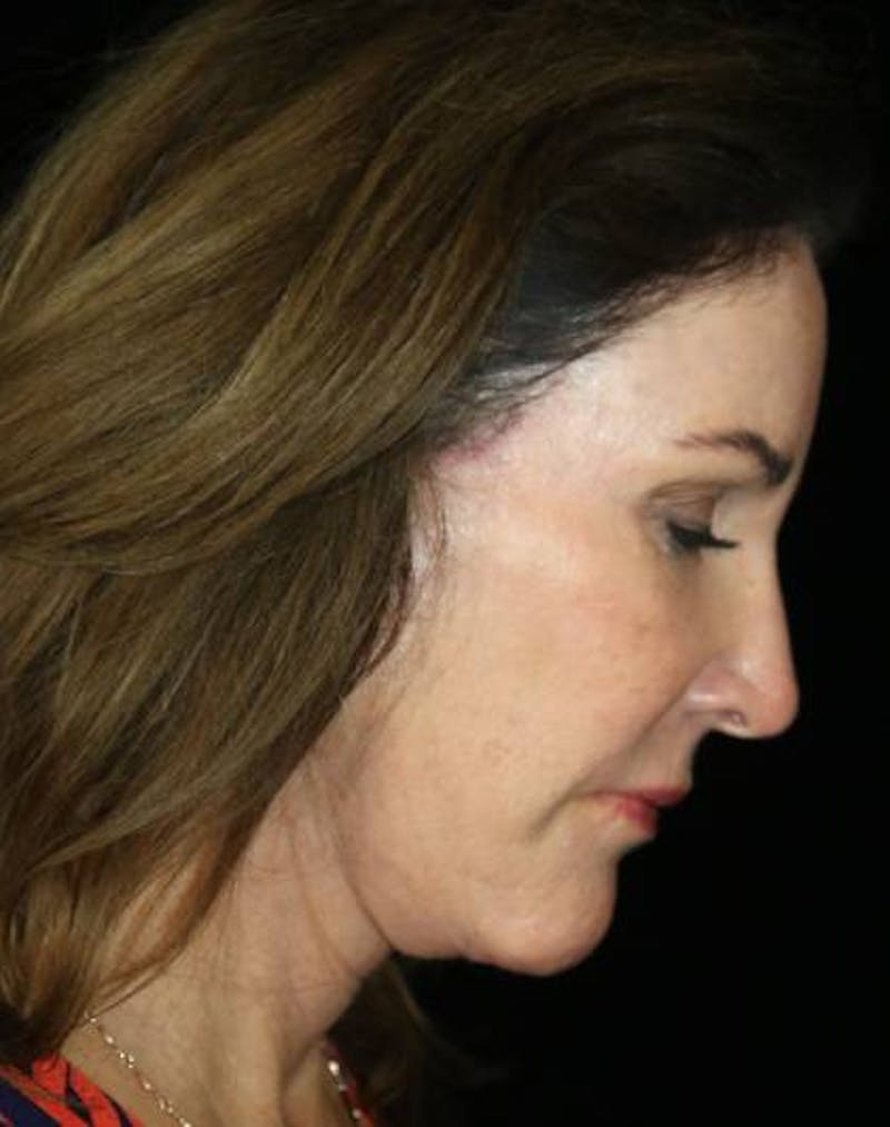 Facial Fat Grafting Before & After Gallery - Patient 221349 - Image 8