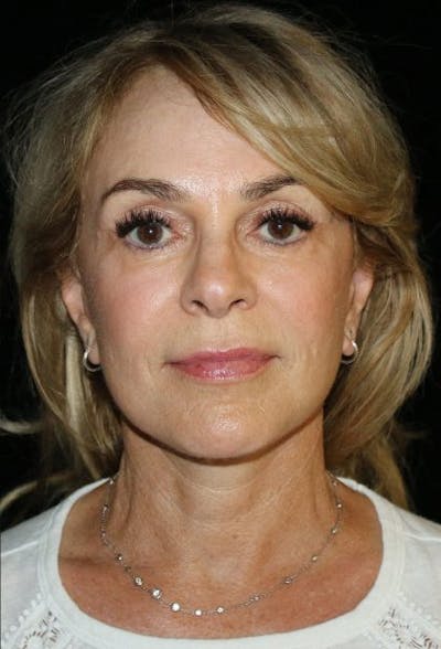 Facial Fat Grafting Before & After Gallery - Patient 321442 - Image 2