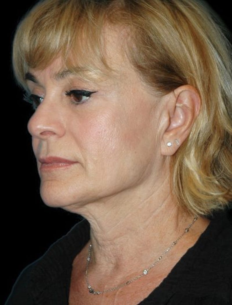 Facial Fat Grafting Before & After Gallery - Patient 321442 - Image 3