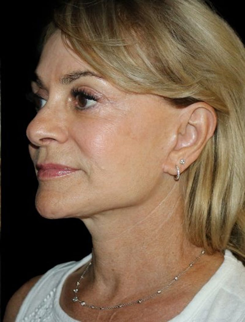 Facial Fat Grafting Before & After Gallery - Patient 321442 - Image 4