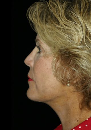 Facial Fat Grafting Before & After Gallery - Patient 119794 - Image 6