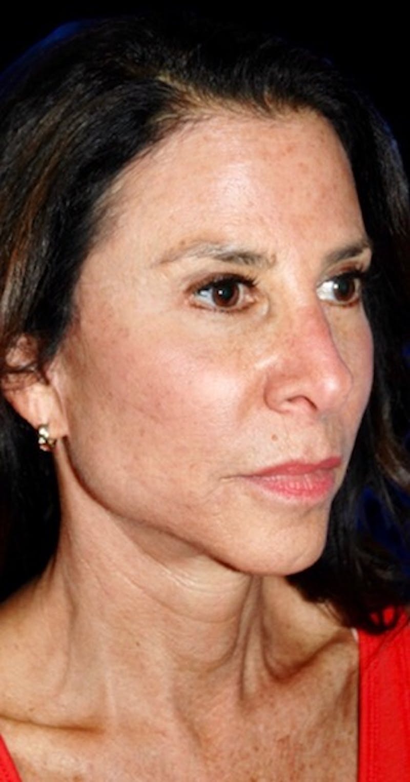 Facial Fat Grafting Before & After Gallery - Patient 874182 - Image 4