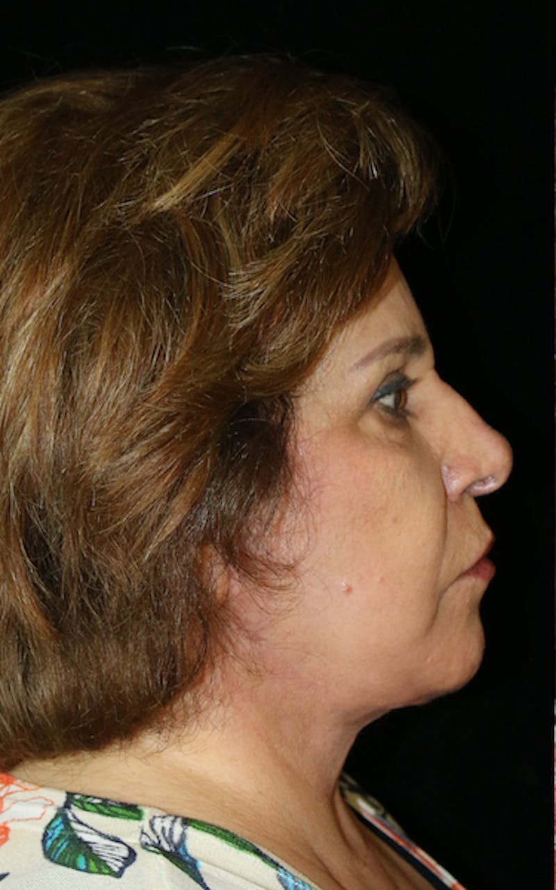 Facial Fat Grafting Before & After Gallery - Patient 653382 - Image 2