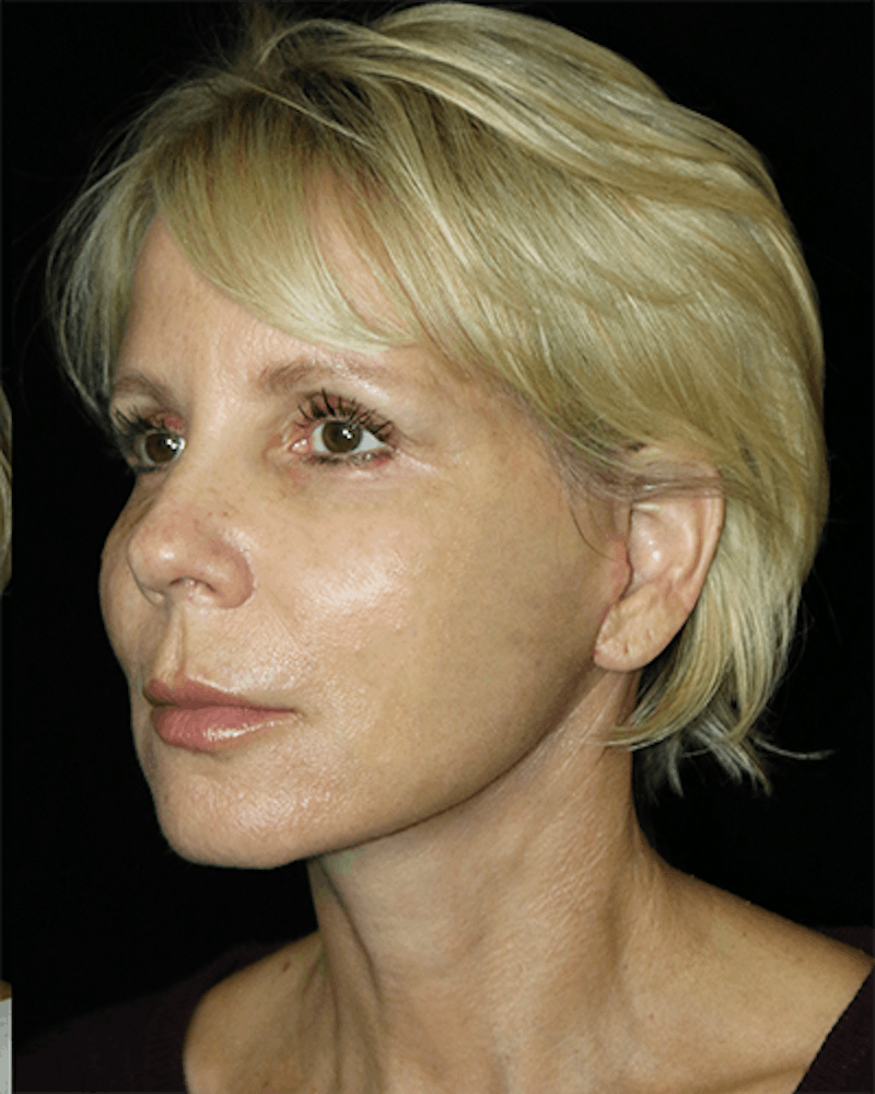 Facial Fat Grafting Before & After Gallery - Patient 528566 - Image 4