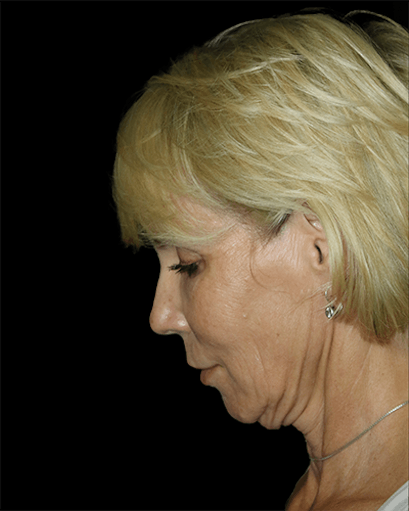 Facial Fat Grafting Before & After Gallery - Patient 528566 - Image 5
