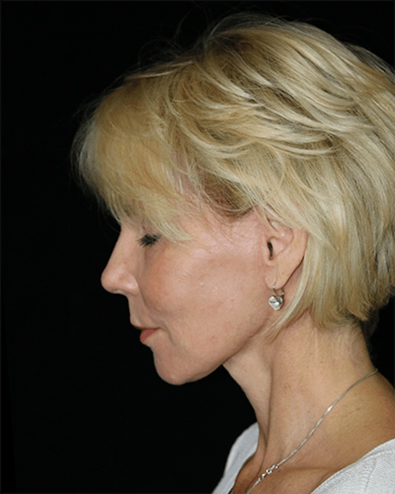 Facial Fat Grafting Before & After Gallery - Patient 528566 - Image 6