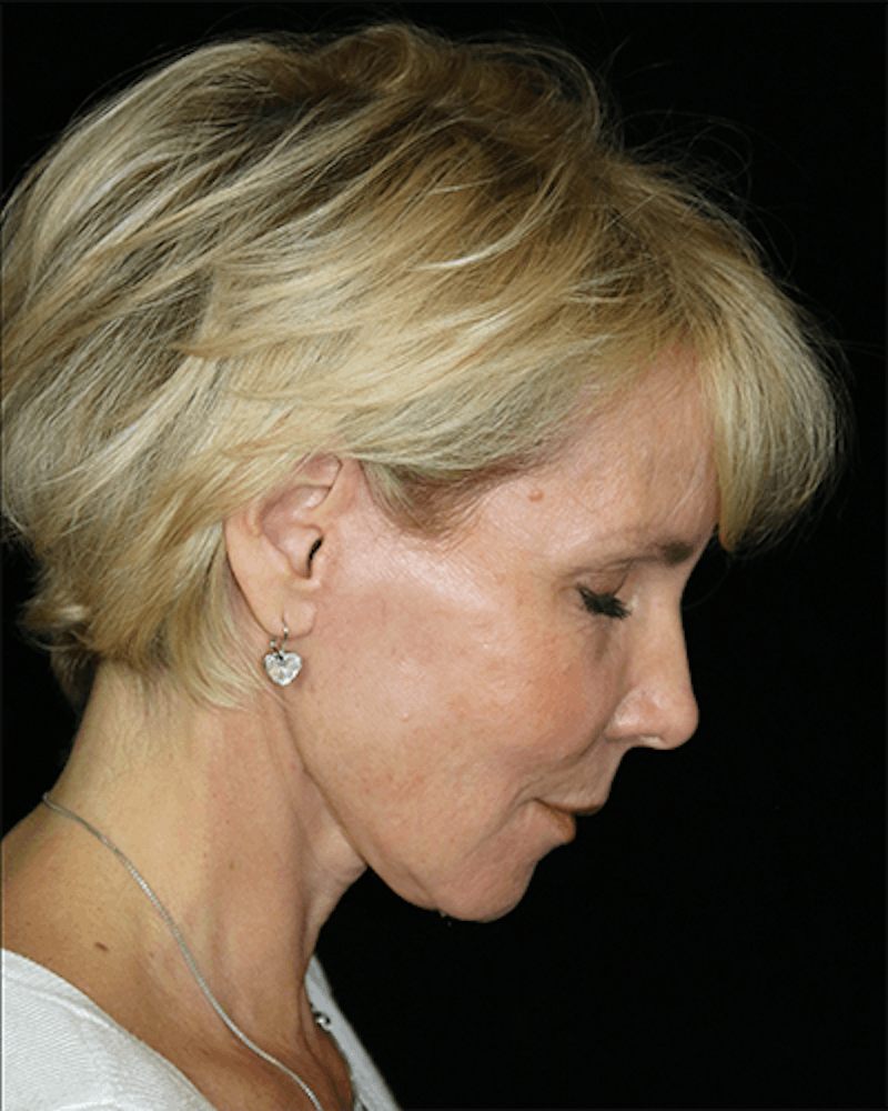 Facial Fat Grafting Before & After Gallery - Patient 528566 - Image 8