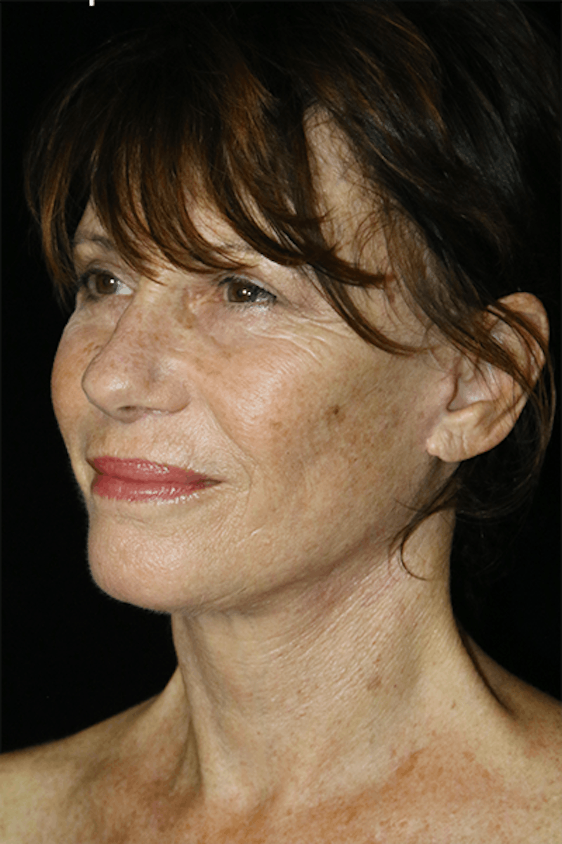 Facial Fat Grafting Before & After Gallery - Patient 404763 - Image 4