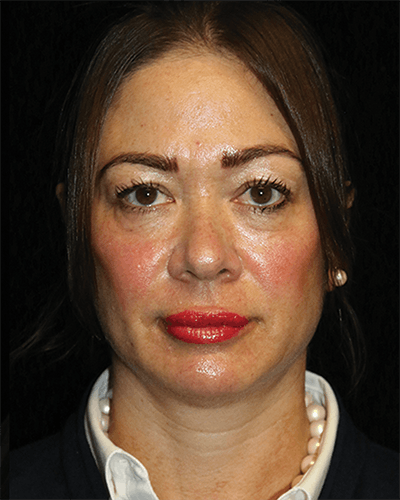 Facial Fat Grafting Before & After Gallery - Patient 299975 - Image 1