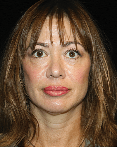 Facial Fat Grafting Before & After Gallery - Patient 299975 - Image 2