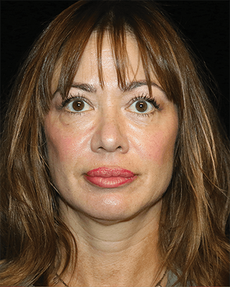 Facial Fat Grafting Before & After Gallery - Patient 299975 - Image 2