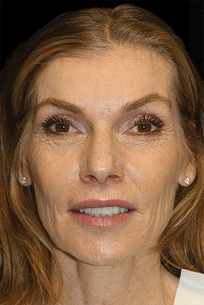 Facial Fat Grafting Before & After Gallery - Patient 324513 - Image 1