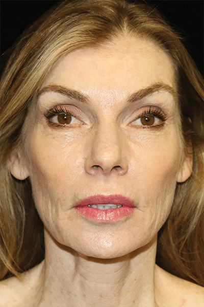 Facial Fat Grafting Before & After Gallery - Patient 324513 - Image 2